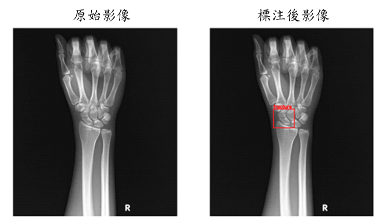 腕部舟狀骨骨折偵測軟體輔助判定結果呈現範例(資料來源：林口長庚醫院)